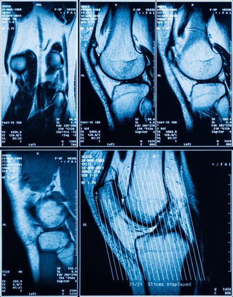 Mar 26, 2021 · a total knee replacement generally requires between one and a half to three hours of operative time. Knee Xray Stock Photos, Pictures & Royalty-Free Images ...