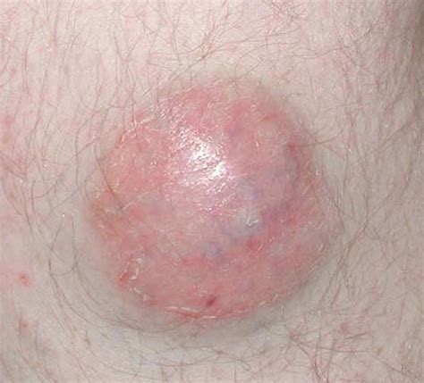 Mcc tends to grow quickly and can be hard to treat if it spreads beyond the skin. Metastatic Merkel-cell carcinoma: the dawn of a new era ...