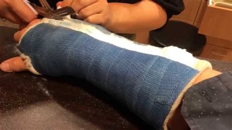 If you have a lighter skin tone and thin hair, consider bleaching your arm hair. Dan's arm cast removal - YouTube