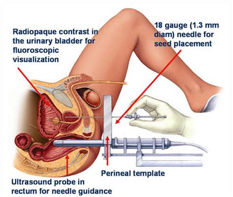 1 carcinomas are cancers that arise in epithelial cells that line bodily cavities. Prostate Cancer