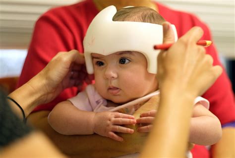 Baby Helmet Therapy on the Rise | KUT Radio, Austin's NPR Station