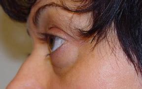 Ursache des pulsierenden exophthalmus ist meist eine verletzung (trauma), die zu einer kurzschlussverbindung (fistel) zwischen der augenarterie und dem sinus cavernosus (eine venöses geflecht an der augenhinterwand) geführt. exoftalmo orbitopatía distiroidea