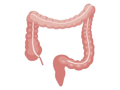 Colorectal cancer can often be prevented through regular screening, which detects polyps before they become cancerous. Colorectal cancer, increasing worldwide : Cancer Awareness ...