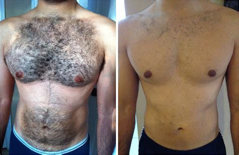 Beauty needs no ornaments but of course, beauty needs some care. Men's Laser Hair Removal - Hertfordshire Laser Hair ...