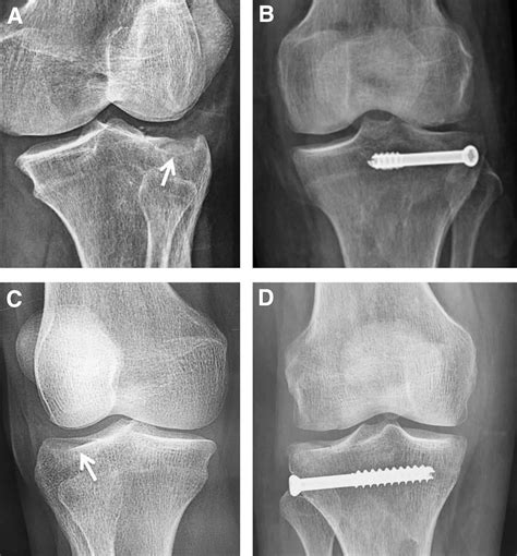 A Fluoroscopy-Free Technique for Percutaneous Screw ...