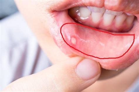 Ursachen und therapie entzündeter lippen. Normal, dass Lippe innen "uneben" ist? (Gesundheit und ...