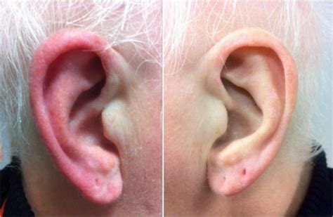 Swollen lymph nodes, infections, and particular cancers can likewise result in lumps. Voici pourquoi votre oreille devient parfois rouge et chaude