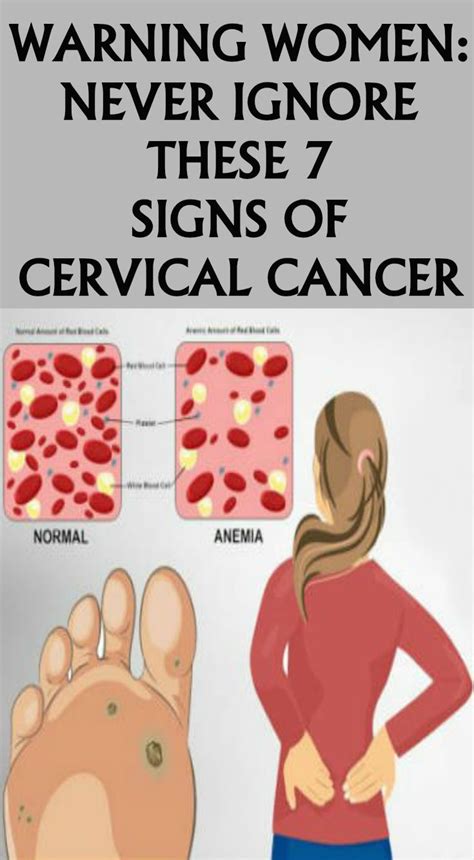 Symptoms of advanced cervical cancer can include: Papilloma lid icd 10, Icd 10 papilloma left eyelid