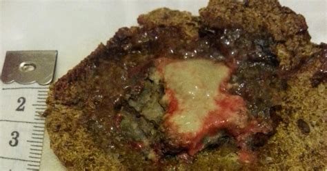 How much pain you feel depends on a number of factors, including the type of cancer you have, how advanced it is, where it's situated and your pain tolerance. The Microwave Factor: Amazing: Woman Cures Breast Cancer ...