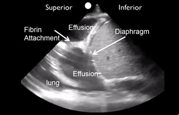 Treatment depends on the cause. Loculated Effusions: