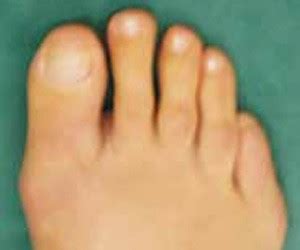 Sie wissen nicht zu welchem arzt sie gehen sollten? hallux-valgus-vn-4-3ebe7c52