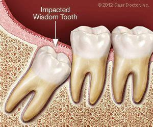 This is because sometimes the wisdom teeth (which is four in number coming in last at the back corners of your. Wisdom Tooth Extraction with Dr. Conness | Ottawa, IL