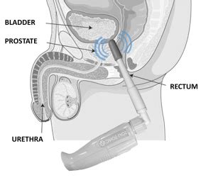 Many people want to know how to stimulate the prostate gland for both medical and sexual purposes. Sonic Prostate Massager, Best Prostate Vibrator by ...