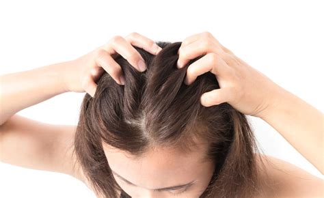 An itchy scalp is the most common symptom. How to Treat Dry, Flaky, and Itchy Scalp | Salon Invi