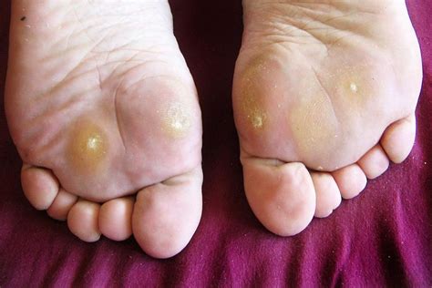 Warts are highly contagious and are mainly passed by direct skin contact, such as when you pick at your warts and then touch another area of you can also spread them with things like towels or razors that have touched a wart on your body or on someone else's. Symptoms, Causes, and Treatment for Plantar Warts