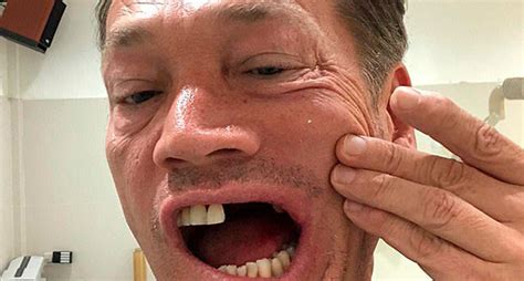 Ormer eastenders star sid owen was left with a broken jaw and smashed teeth after a horrific golfing accident. Golfer Requires 15 Hours Of Facial Reconstruction Surgery ...