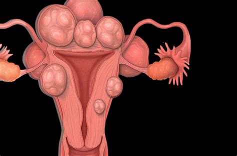 These fibroids are made up of groups of muscle cells and other tissues, and can range in size from as small as a pea to as large as 5 to 6 inches (12.7 to 15.24 centimeters) wide. What Are Uterine Fibroids? Very Common, Benign ...