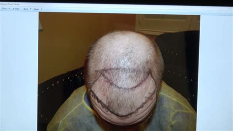 Hair growth is possible with advanced hair studio. Advanced Hair Loss Bald Restored by FUE Hair Transplant ...