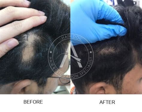 Female pattern hair loss and androgen excess: Alopecia Areata Solutions Malaysia | Alopecia Areata ...