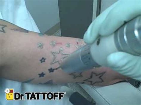 Tattoo removal has been performed with various tools since the start of tattooing. Houston Tattoo Removal - Stars Tattoo Removed at Dr ...