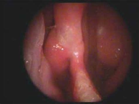 The chronic crusting, foul odor, nosebleeds and. Septal perforation on location of the median nasal septum ...