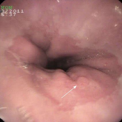 Preliminary results of 5 years study in single center. Diagnostic Accuracy of Gastroesophageal Reflux Disease ...