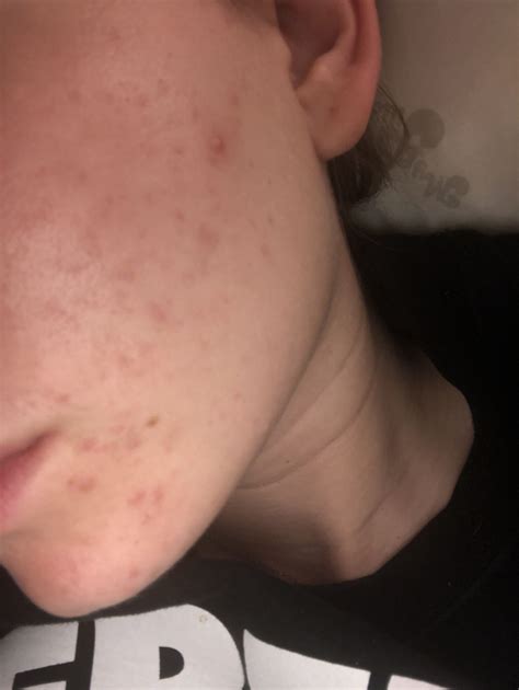 Flares up before your period, during menopause, during pregnancy or other phases of life when there's a significant shift in hormones. Can anyone tell me what kind of acne I have? Photo ...