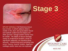 An alginate dressing is not used for stage 1 pressure injuries. Deep Tissue Pressure Injury (DTPI) NPUAP definition ...