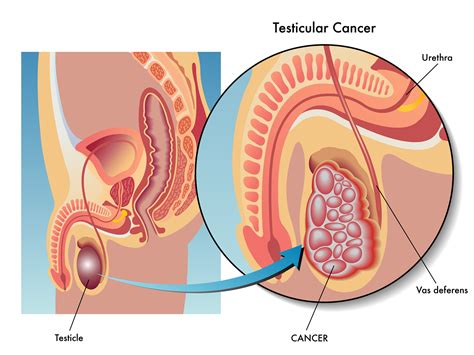 What are the symptoms of testicular cancer? Germ Cell Tumors And Testicular Cancer - Net Health Book