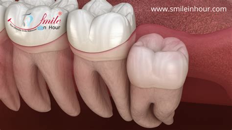 Low cost and high quality services are provided for overseas patients at the clinic. Wisdom Teeth Removal Extraction cost India smile in hour ...