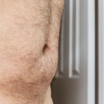 Surgery will also be needed if your intestines or other organ get trapped inside the hernia. Side View Of Umbilical Hernia Belly Button Scar Stock Photo - Download Image Now - iStock