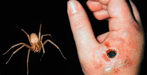 La araña de patas largas o araña patona, también referidas como fólcidos, es una araña de la familia pholcidae. Exhortan los Servicios de Salud a prevenir picaduras de ...