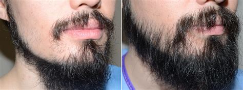 But it gets even worse when your facial hair starts turning white. Facial Hair Photos | Miami, FL | Patient 58902