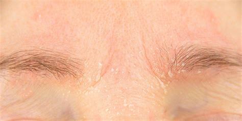 Your skin becomes irritated and sometimes itchy as a result of allergic reactions to skin products or foods. Eyebrow Dandruff Is a Thing—Here's How to Treat It ...