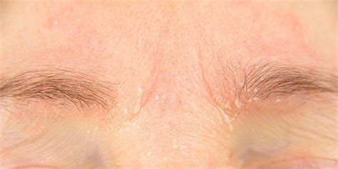 Your skin becomes irritated and sometimes itchy as a result of allergic reactions to skin products or foods. Eyebrow Dandruff Is a Thing—Here's How to Treat It ...