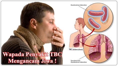 Maybe you would like to learn more about one of these? Obat Herbal TB Paru Aktif - Len OnLine Herbal