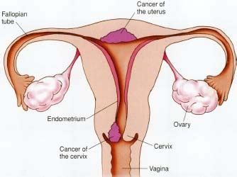 Endometrial cancer occurs most often after menopause. Health & Fitness: Stage 4 Prostate Cancer Symptoms
