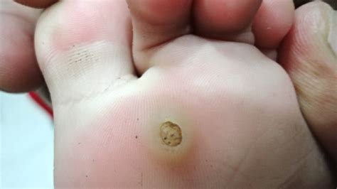 When skin cells become infected with hpv, the virus tends to make. How to Get Rid of Plantar Warts - Removal and Treatment ...