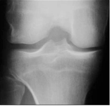 Knee Imaging - Knee & Sports - Orthobullets