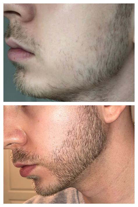 After all, the first steps alone will take you four hours to complete. Minoxidil Guide for Thicker Beard, Facial Hair and Fuller ...