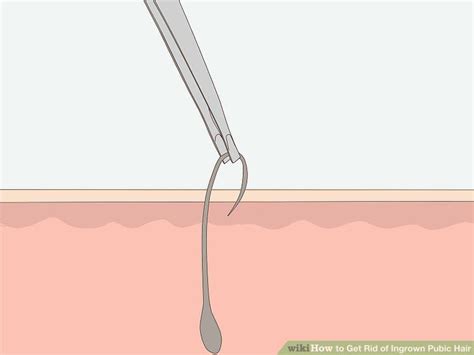 Many medical experts will commonly say that you can use a sterile needle or tweezers to gently release the if you're wondering how to get rid of ingrown hairs on legs or any other area of your body, you'll want to avoid wearing clothing that is tight and/or. Pin on Dark bikini area