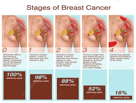 A breast is made up of three main parts: Breast Cancer Stages, Illustration - Stock Image - C027 ...