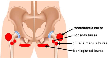 How long can bursitis last? Greater Trochanteric Syndrome (outer hip pain) Guide