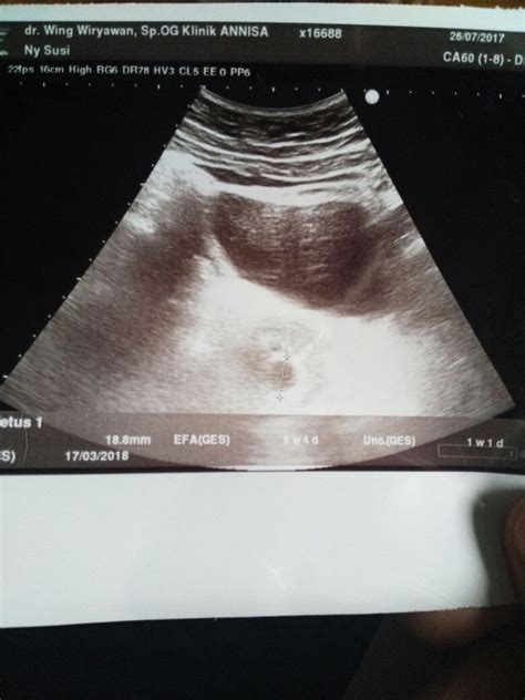 Biaya usg adalah salah satu hal yang harus diketahui ketika wanita hamil hendak mengecek kandungan dengan ultrasonografi medis atau usg. Ukuran Janin 8 Minggu Berapa Cm - Berbagai Ukuran