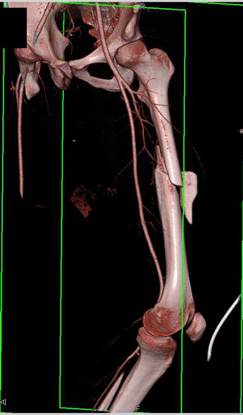 Spiral fractures result from a rotatory mechanism; Spiral Femur Fracture Without Vascular Injury - Musculoskeletal Case Studies - CTisus CT Scanning