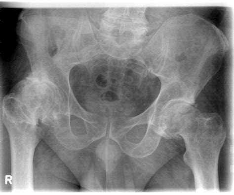 Hüftgelenksarthrose, arthrosis deformans coxae englisch: Hüftendoprothesen - arthrOWL Bünde