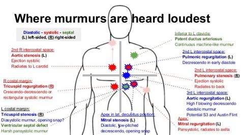 Murmur definition, a low, continuous sound, as of a brook, the wind, or trees, or of low, indistinct to murmur is to utter sounds or words in a low, almost inaudible tone, as in expressing affection or. Where murmurs are heard loudest 2nd L intercostal space ...