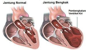 Jantung berdebar (palpitasi) adalah kondisi yang berkaitan dengan detak jantung. Obat Herbal Jantung Bengkak | QnC Jelly Gamat-100% Alami ...