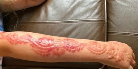 Membuat tato membutuhkan komitmen besar. Lukis Tato Henna, Gadis Kecil Ini Terancam Cacat Permanen ...