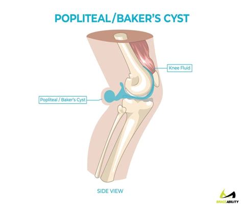 Kondisi ini biasanya terjadi seiring bertambahnya usia dan merupakan hasil penipisan tulang rawan di dalam lutut. Ketahui Penyebab Sering Merasa Nyeri di Belakang Lutut